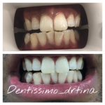 Teeth whitening case