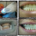Teeth whitening case