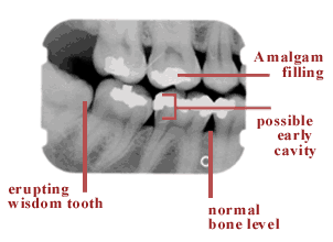 Dental X-rays reveal a lot
