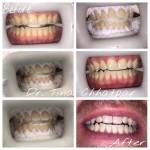 Teeth Whitening case
