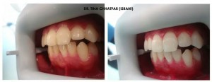 Before & After -  Zoom! Teeth Whitening