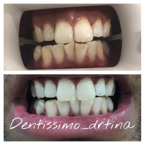 Teeth whitening: Before & After