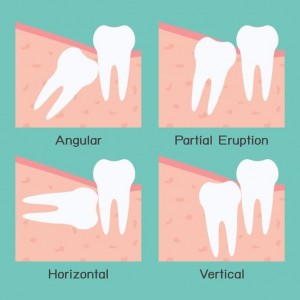 Wisdom teeth explained